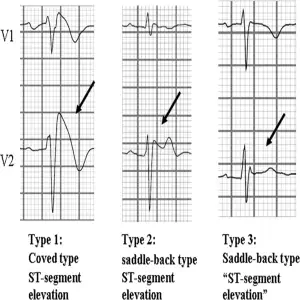 Brugada Types